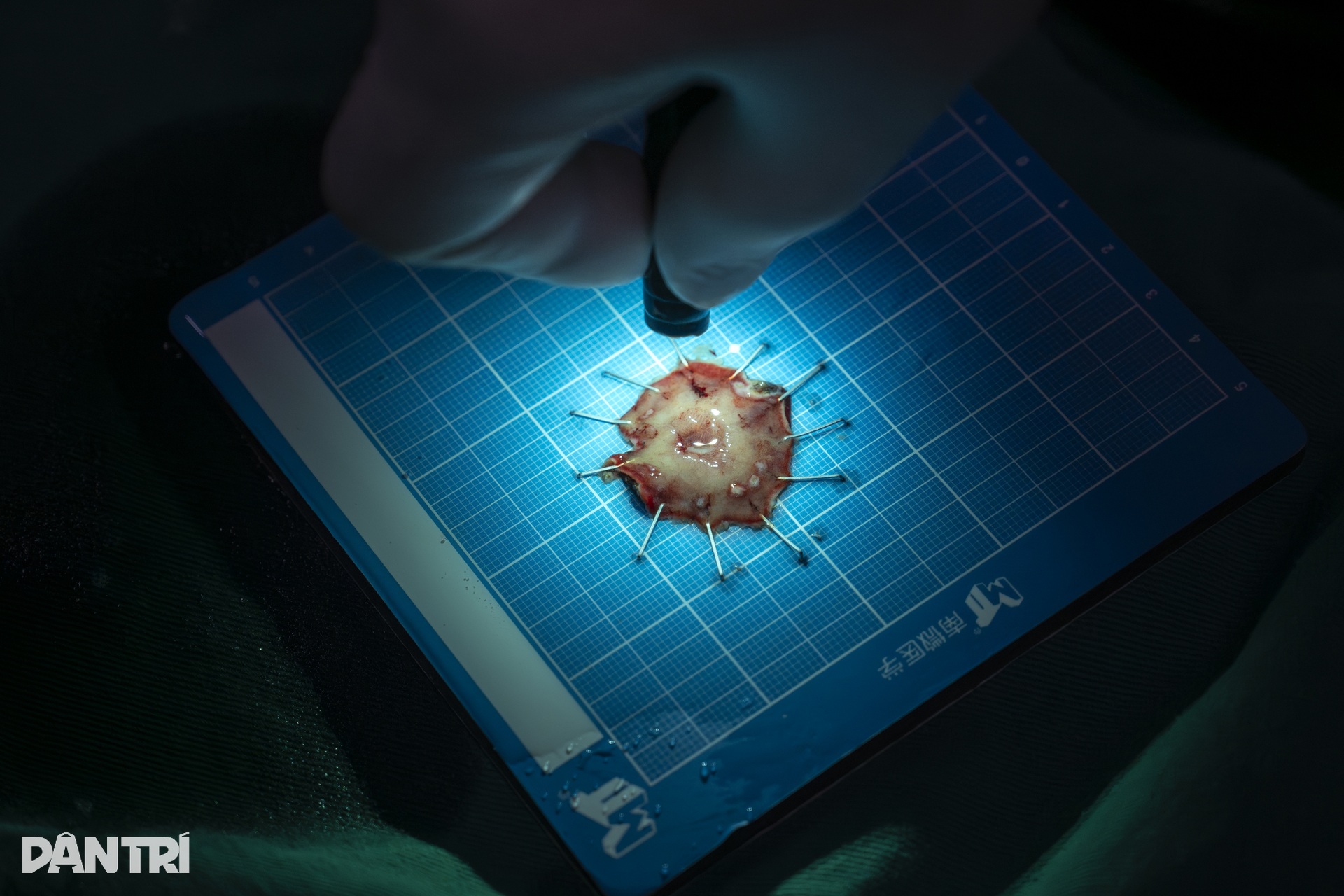 Xem bác sĩ biến ung thư thành bong bóng, loại bỏ hoàn toàn khỏi dạ dày - 20