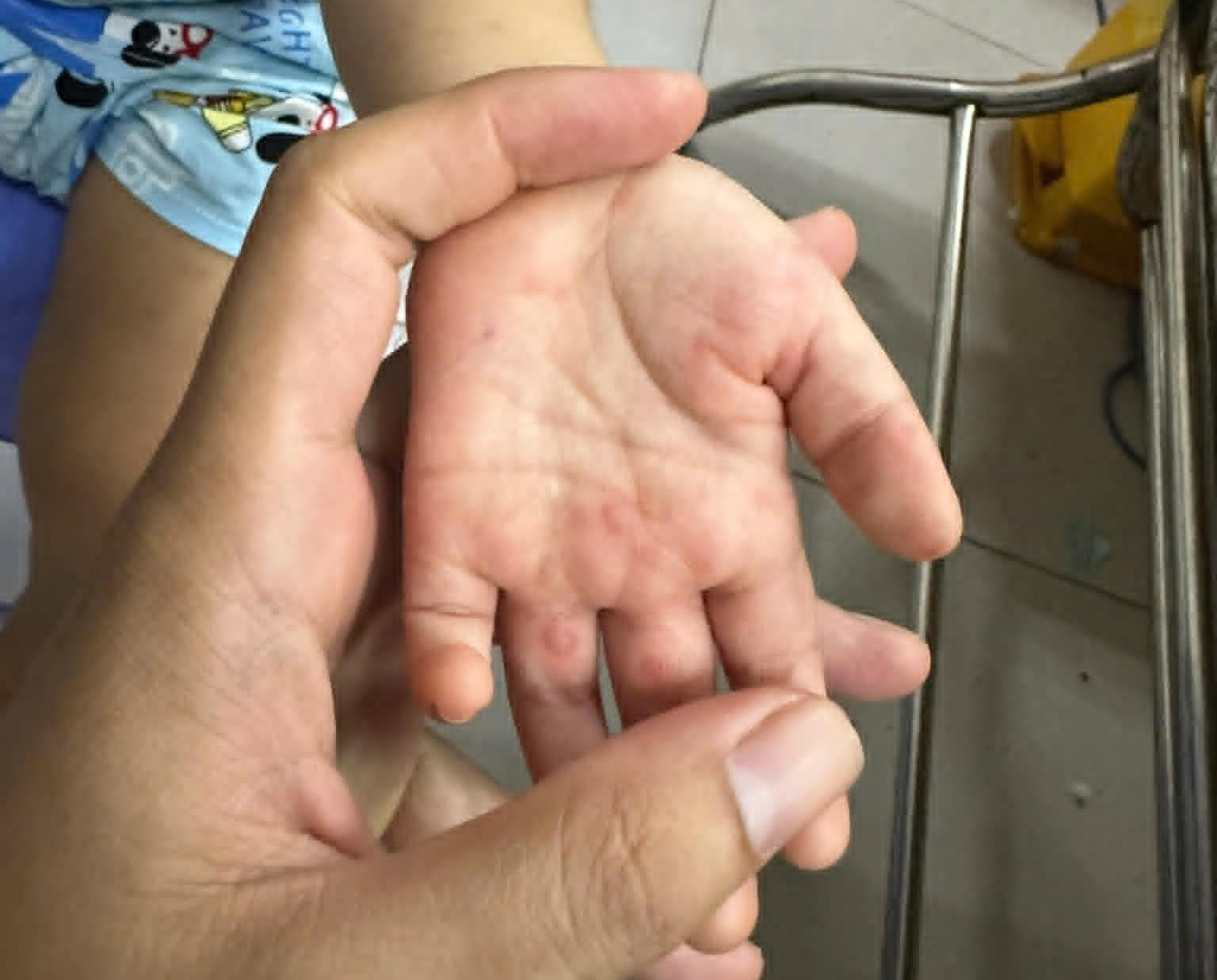 tay chân miệng - Ảnh 2.