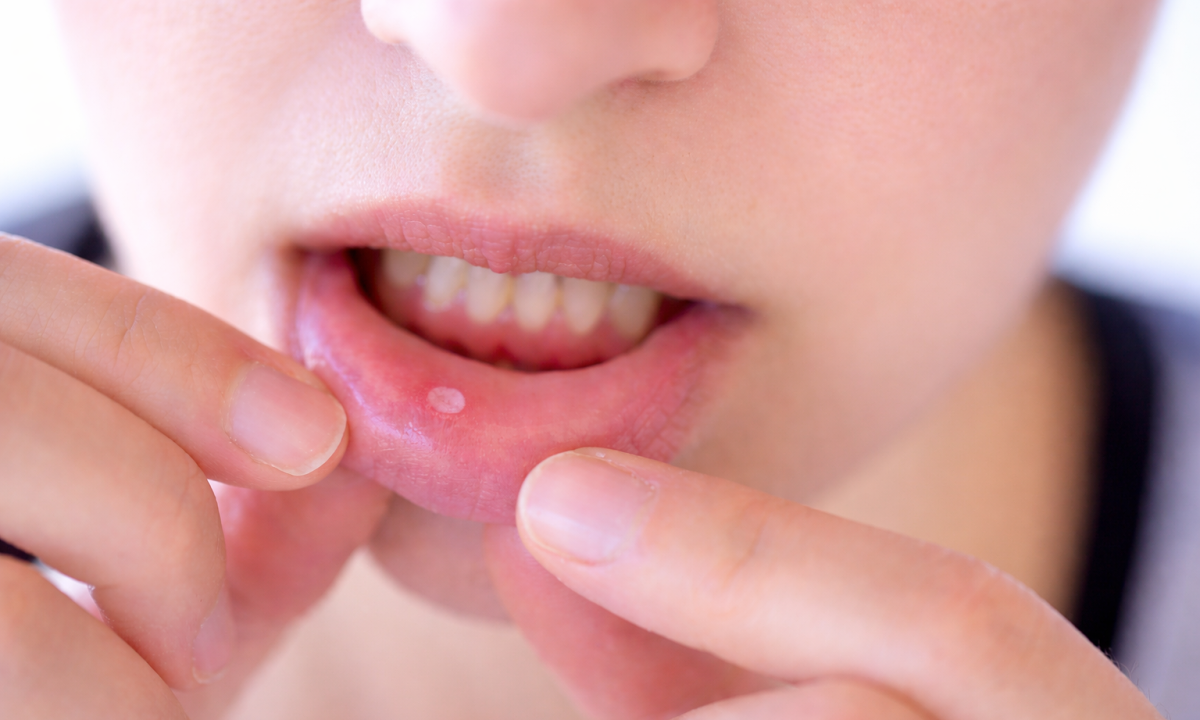 6 dau hieu o mieng co the canh bao thieu