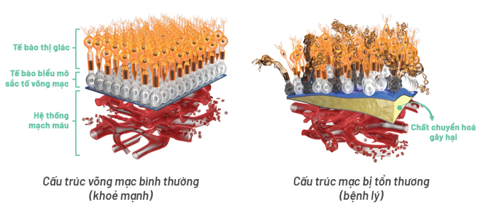 Võng mạc khỏe mạnh (trái) và võng mạc tổn thương (phải) do nhiều yếu tố như lão hóa và các chất chuyển hóa gây hại. Ảnh: Công ty Cổ phần Dược phẩm Eco