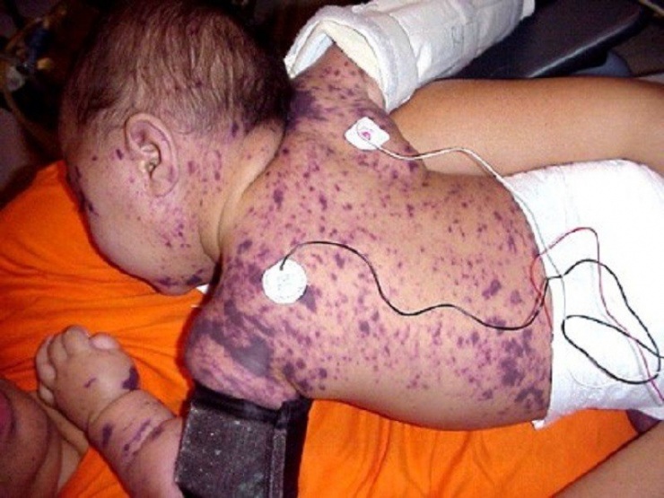 Bác sĩ cảnh báo sau ca tử vong do não mô cầu 1 Từ ban bùng phát trên cơ thể bệnh nhi mắc não mô cầu (ảnh minh họa)
