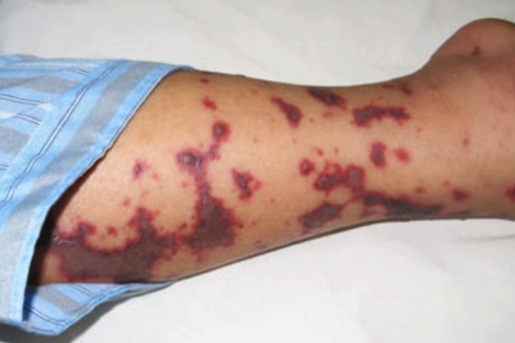 Bé gái ở Phú Quốc tử vong sau mắc não mô cầu: Chuyên gia nhi khoa nói gì? - 1