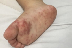 Dịch tay chân miệng “nóng” trở lại, trẻ nhỏ đối mặt nguy cơ biến chứng nặng