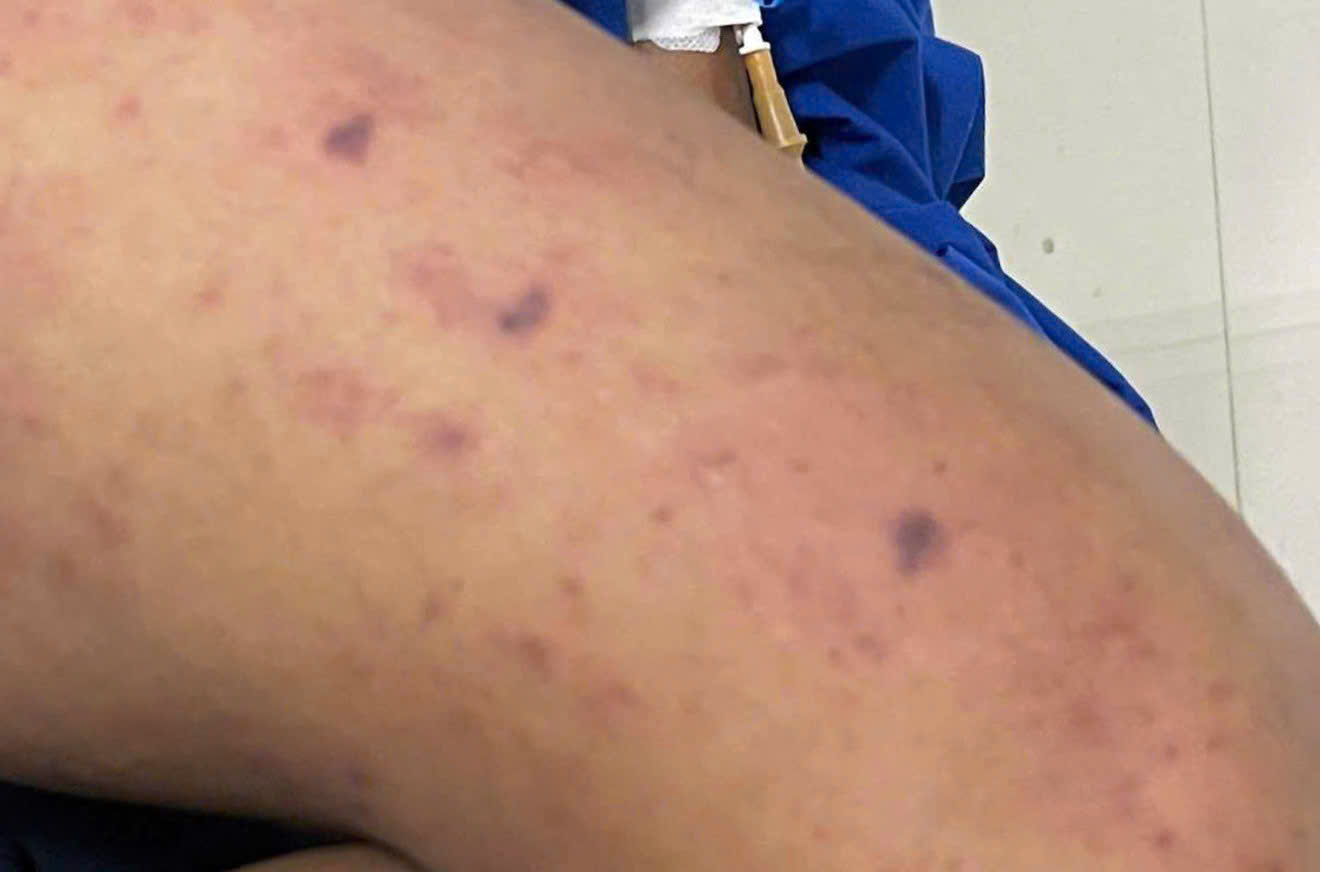 viêm não mô cầu - Ảnh 1.