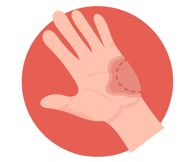 Vết cắn của người. Ảnh minh họa: Vecteezy