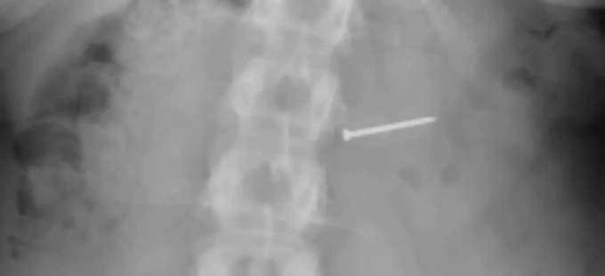 Hình ảnh chụp X quang của Brandy Buckley. Ảnh: NYPost