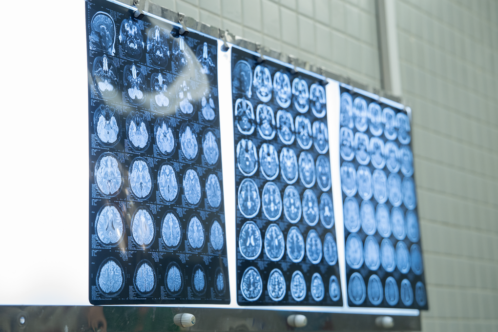 Căn bệnh hiểm khiến cô gái 20 tuổi liệt nửa người sau nhiều cơn đau đầu - 1