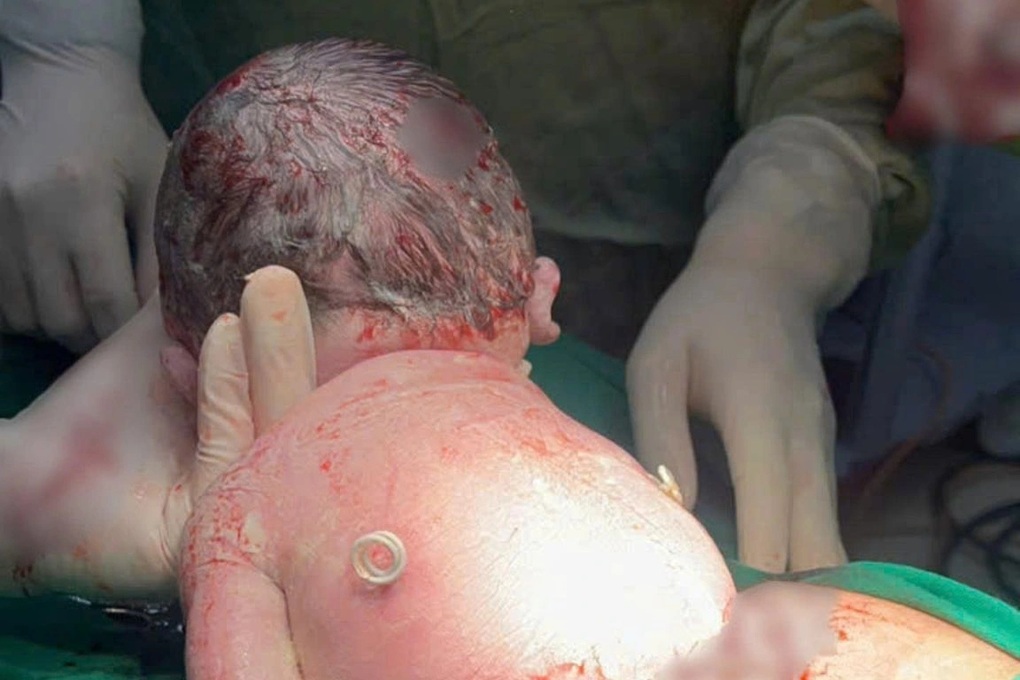 Can thiệp bào thai thành công, em bé mang “đôi cánh tí hon” chào đời - 1