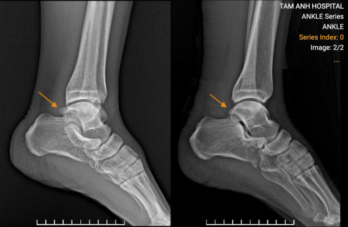 Xương thừa (chồi xương) ở gót chân anh Tuấn (bên trái) sau khi được nội soi cắt bỏ (bên phải). Ảnh: Bệnh viện Đa khoa Tâm Anh