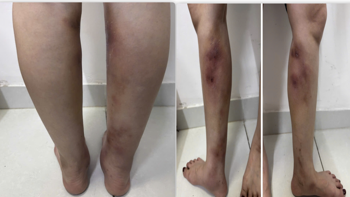 tiêm filler - Ảnh 1.