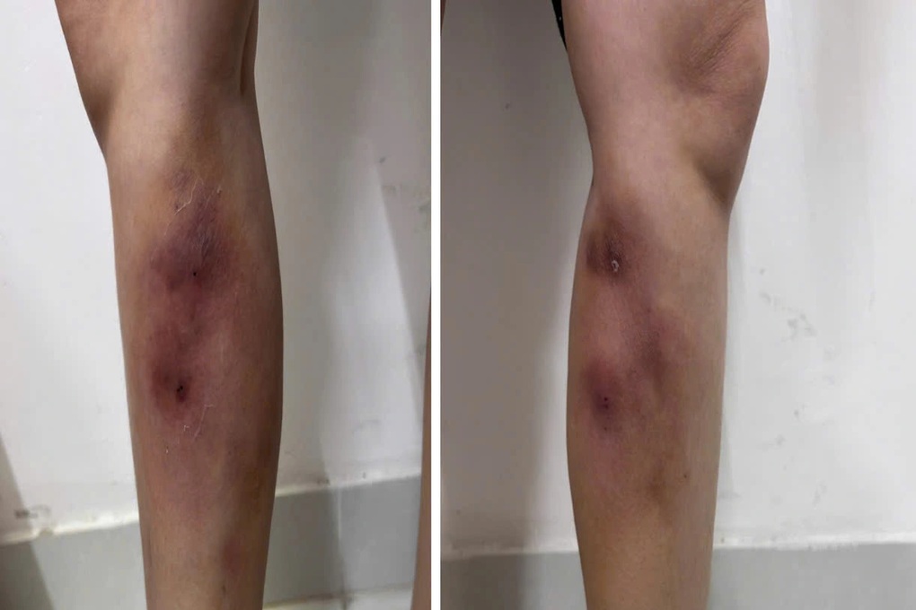 Cô gái gặp họa vì tiêm filler nắn thẳng chân - 1