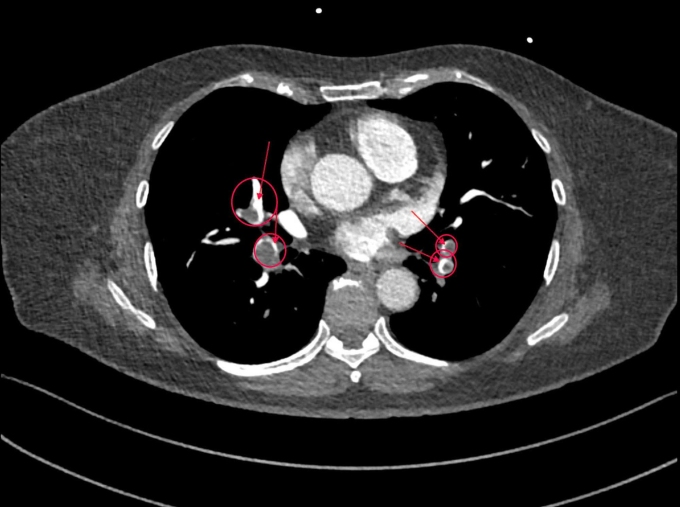 Kỹ thuật Triple Rule Out được thực hiện dưới sự hỗ trợ của hệ thống máy CT Somatom Force VB30 phát hiện huyết khối xuất hiện ở nhiều nhánh động mạch phổi (khoanh đỏ). Ảnh: Bệnh viện Đa khoa Tâm Anh
