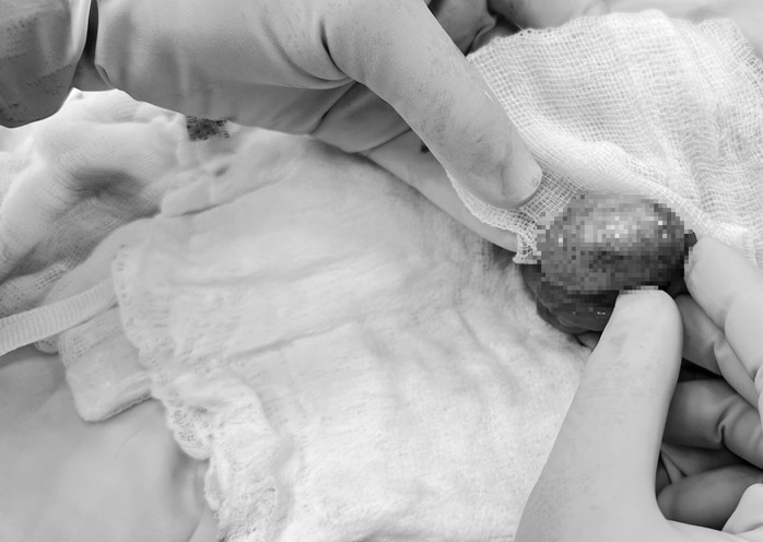 Trong quá trình mổ, ê-kíp ghi nhận tinh hoàn trái bị xoắn hai vòng, tím đen do thiếu máu nuôi