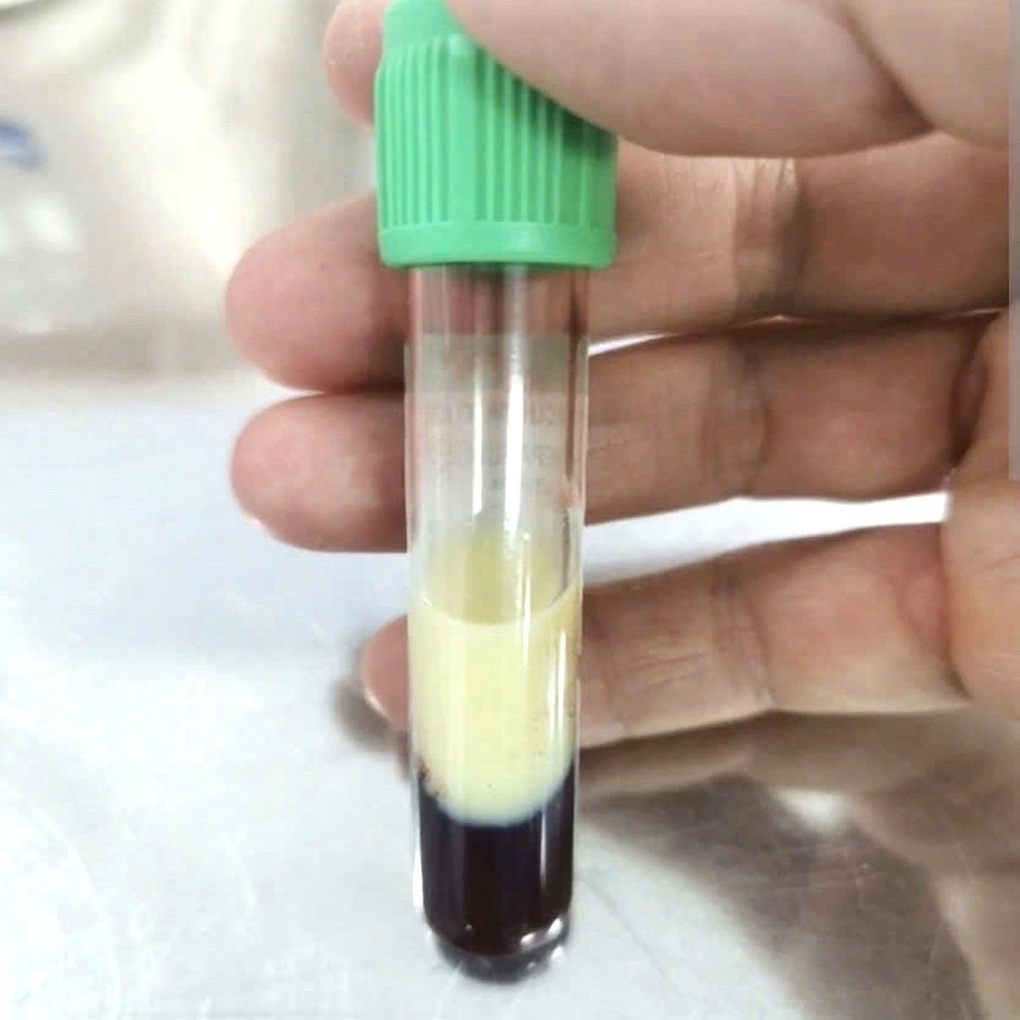 Đau bụng dữ dội, bệnh nhân nhập viện vì mỡ máu cao gấp 40 lần, viêm tụy cấp - 1