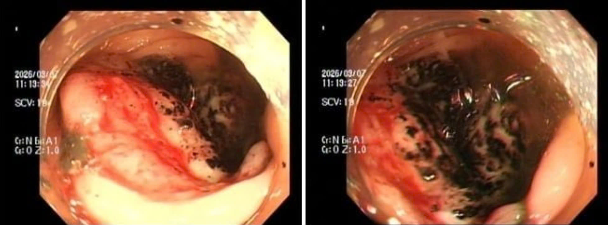 Đau bụng tưởng bình thường, nhiều người trẻ mắc ung thư đại trực tràng khi đã muộn- Ảnh 1.