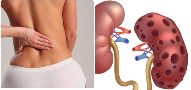 Dấu hiệu suy thận ở nữ giới dễ bị bỏ qua, chị em có dấu hiệu này cần được khám sớm 1 Ảnh minh họa.