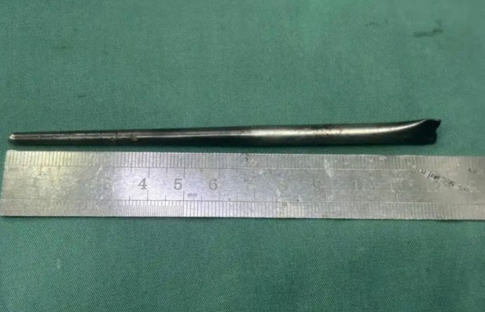 Đũa kim loại 12 cm trong cổ họng người đàn ông suốt 8 năm/Người đàn ông chung sống với chiếc đũa trong cổ họng suốt 8 năm