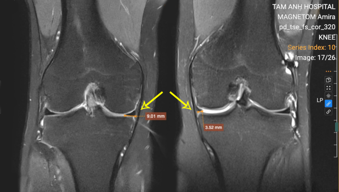 Khớp gối trái của Quang khuyết thiếu sụn chêm trong so với gối phải. Ảnh: Bệnh viện Đa khoa Tâm Anh