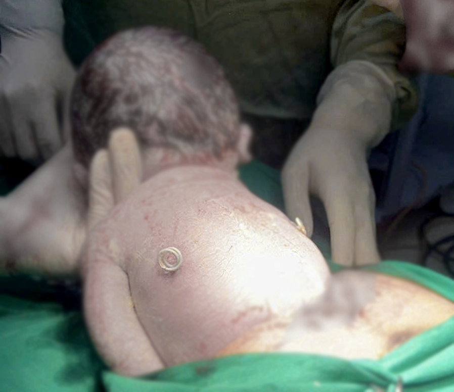 Em bé sinh ra với ‘đôi cánh nhỏ’ trên lưng 1 em bé - Ảnh 1.