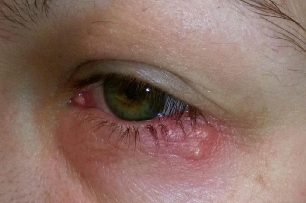 Gia tăng người mắc sùi mào gà, giang mai vào bệnh viện cầu cứu - 1