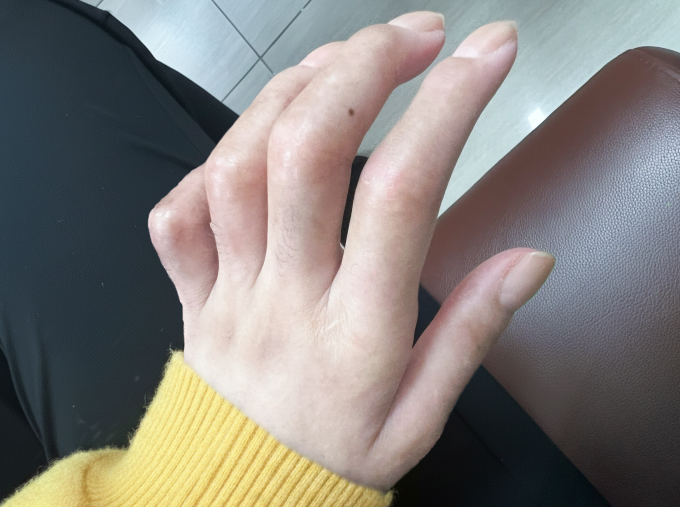 Bàn tay chị Tú sưng, căng cứng khớp không thể cầm nắm, co duỗi do bệnh. Ảnh: Bệnh viện Đa khoa Tâm Anh