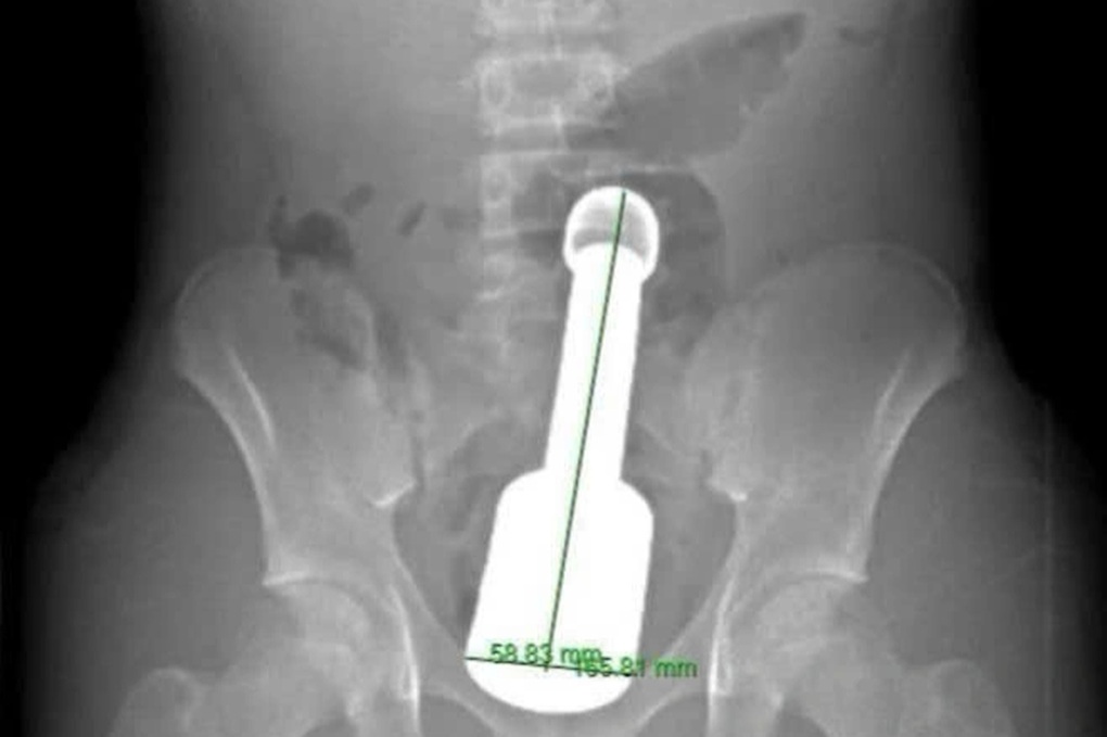 Hà Nội: Bác sĩ lấy dị vật kim loại bị kẹt trong trực tràng bé trai 15 tuổi - 1