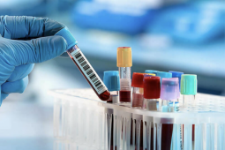 Huyết tương đặc như sữa sau 7 lần viêm tụy cấp