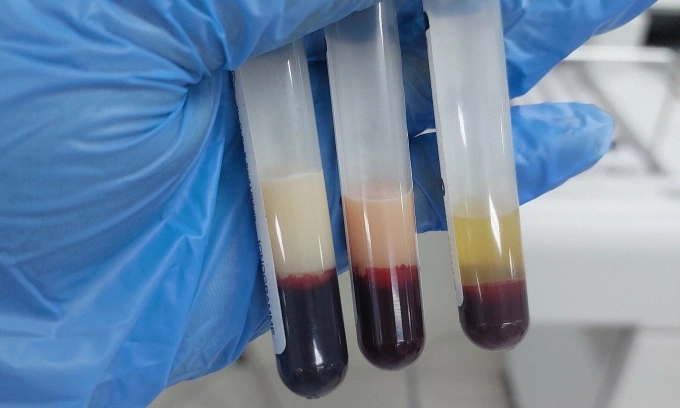 Kết quả xét nghiệm máu của bệnh nhân viêm tụy cấp. Ảnh minh họa: Hoàng Sơn