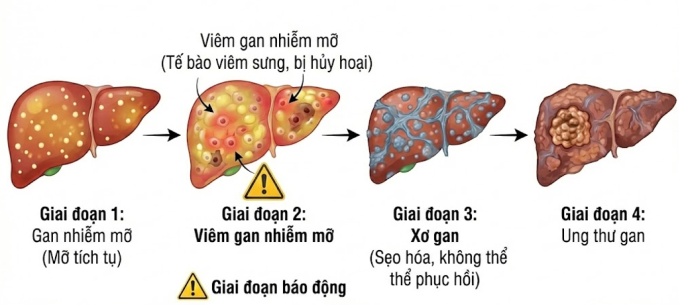 Các giai đoạn của bệnh gan nhiễm mỡ. Ảnh: Bác sĩ cung cấp