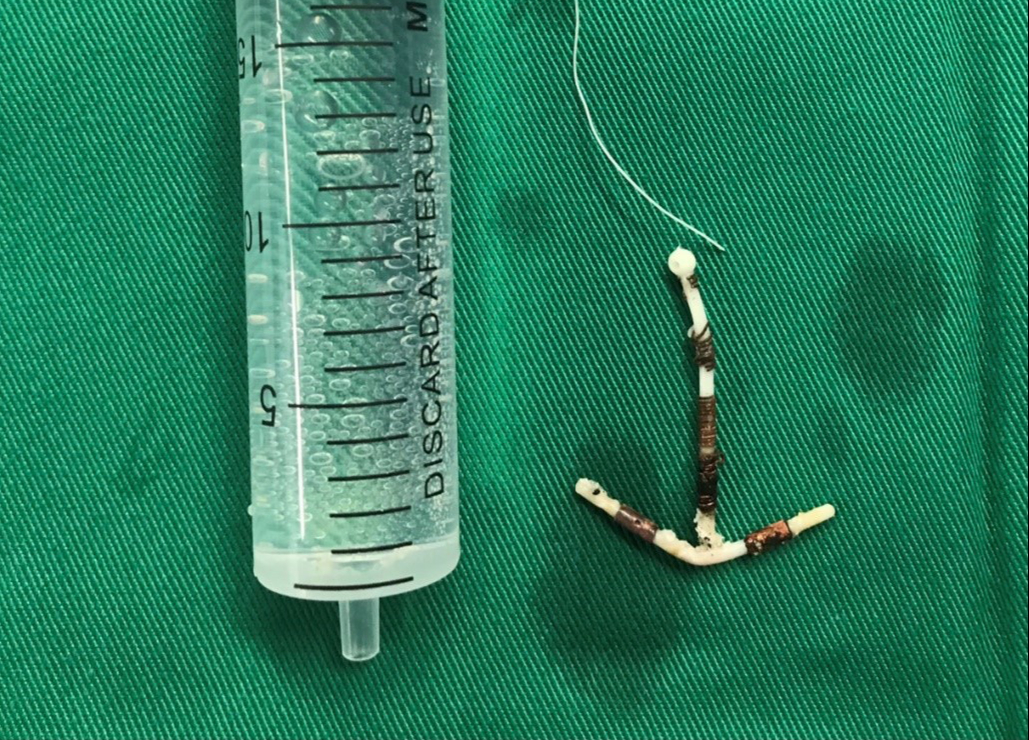 tránh thai - Ảnh 1.