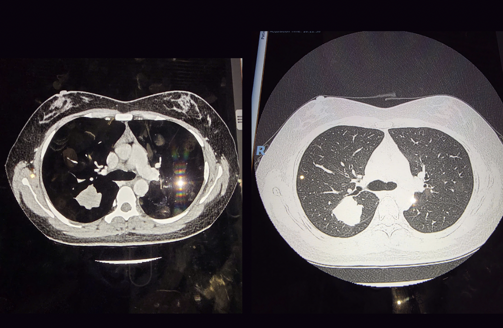 Mắt thần phát hiện nốt mờ giúp thay đổi số phận bệnh nhân ung thư phổi - 1