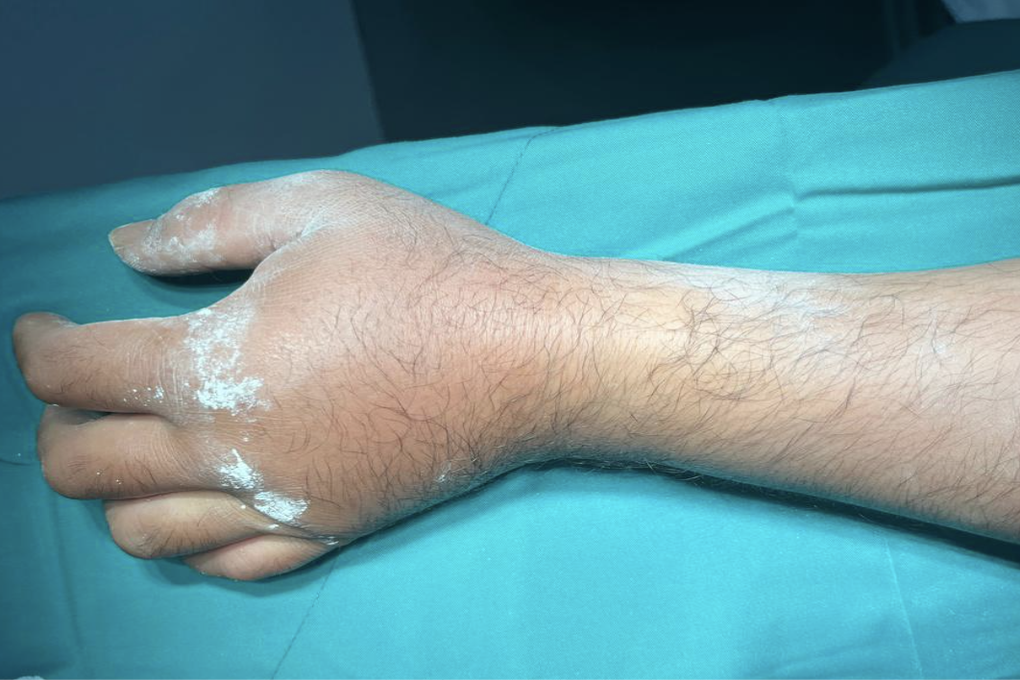 Ngã xe chống tay theo phản xạ, nhiều người phải mổ cổ tay - 1