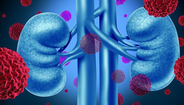 Người đàn ông bất ngờ phát hiện mắc ung thư thận từ dấu hiệu nhiều người Việt bỏ qua 1 Ảnh minh họa.