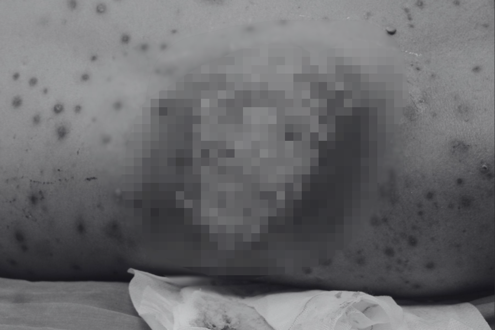 Người đàn ông suýt chết vì... một nốt mụn nhọt - 1