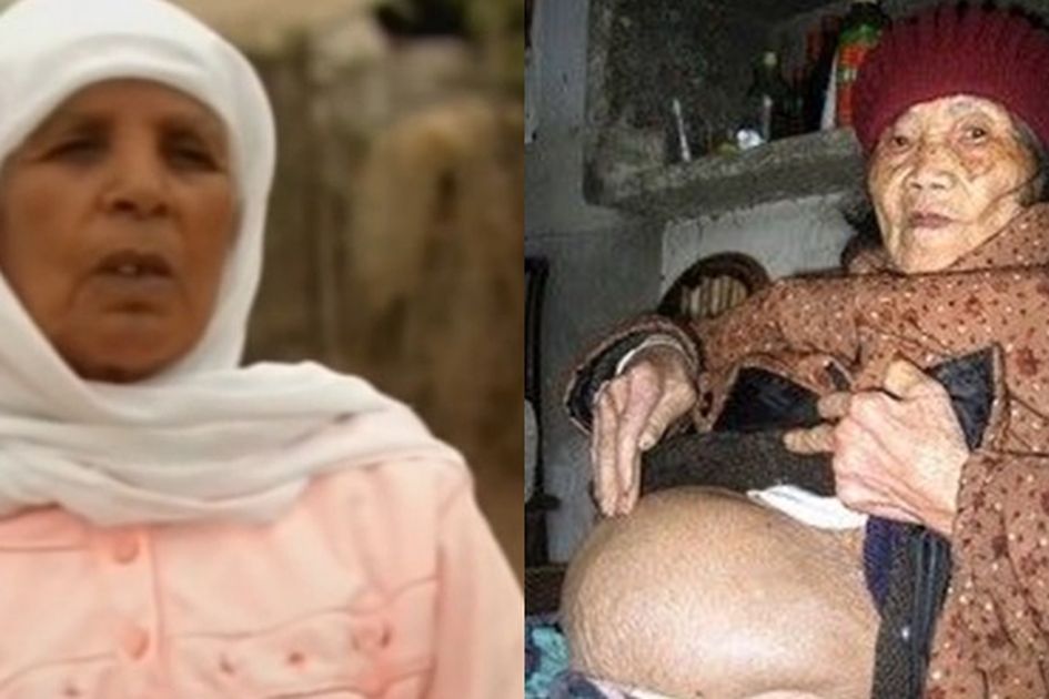 Người phụ nữ mang thai suốt 46 năm mà không hề hay biết cho đến khi 75 tuổi- Ảnh 1.