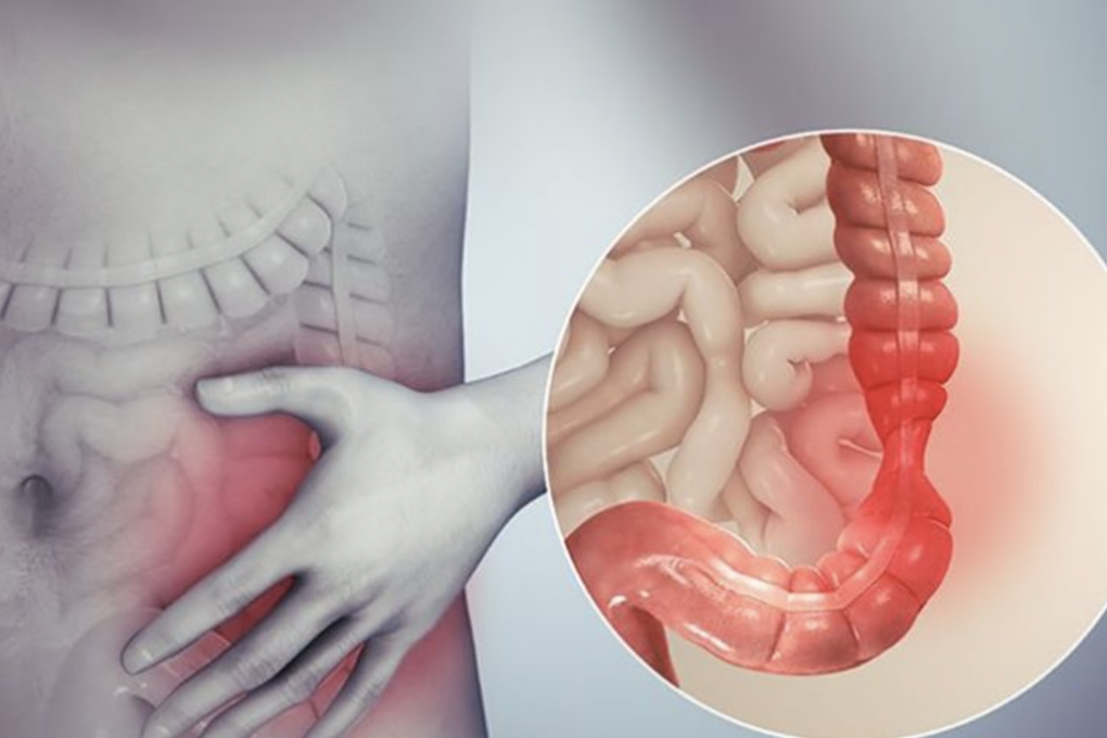 Nhiều người cứ ăn vào là đau bụng đi tiêu: Bệnh gì, chữa được không? - 1