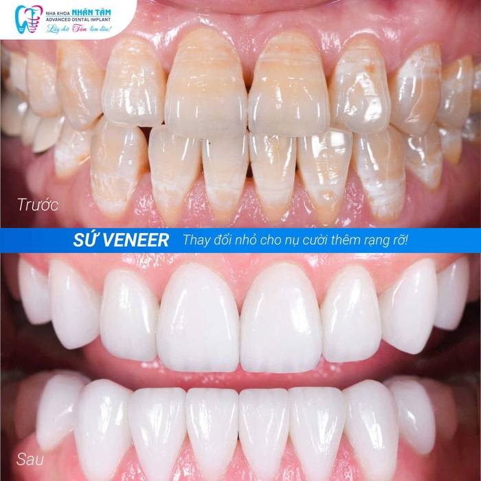 Những màn "lột xác" nụ cười từ triết lý Xâm lấn tối thiểu – Độ bền tối đa tại Nha khoa Nhân Tâm 1 Showcase: Những màn lột xác nụ cười từ triết lý Xâm lấn tối thiểu – Độ bền tối đa tại Nha khoa Nhân Tâm