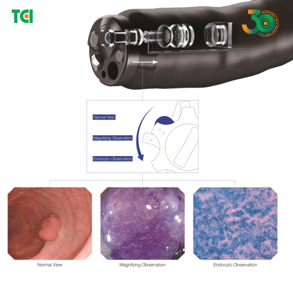 Nội soi tiêu hóa phóng đại 520 lần: Bước tiến trong phát hiện ung thư sớm ở cấp độ tế bào - 1