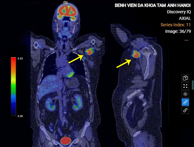 Tổ chức u lympho lớn tại hố nách trái người bệnh trên phim chụp PET/CT. Ảnh: Bệnh viện Đa khoa Tâm Anh