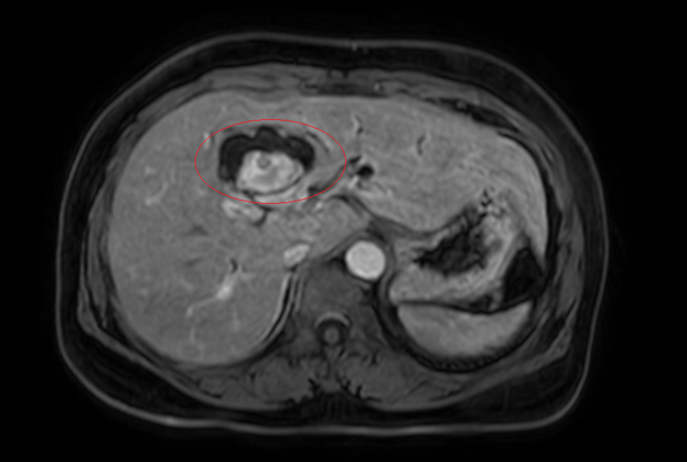 Hình ảnh giãn khu trú đường mật gan trái, tạo cấu trúc dạng nang. Ảnh: Bệnh viện cung cấp
