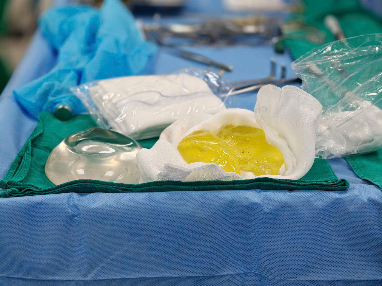 túi ngực - Ảnh 1.