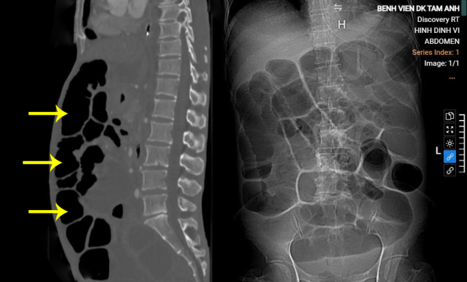 Bụng người bệnh chướng khí, ứ đọng dịch tiêu hóa, quai ruột giãn rộng trên ảnh chụp CT. Ảnh: Bệnh viện Đa khoa Tâm Anh