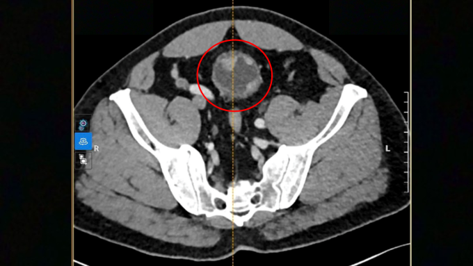 Ảnh CT ghi nhận khối u to bất thường xâm lấn cơ bàng quang người bệnh. Ảnh: Bệnh viện Đa khoa Tâm Anh