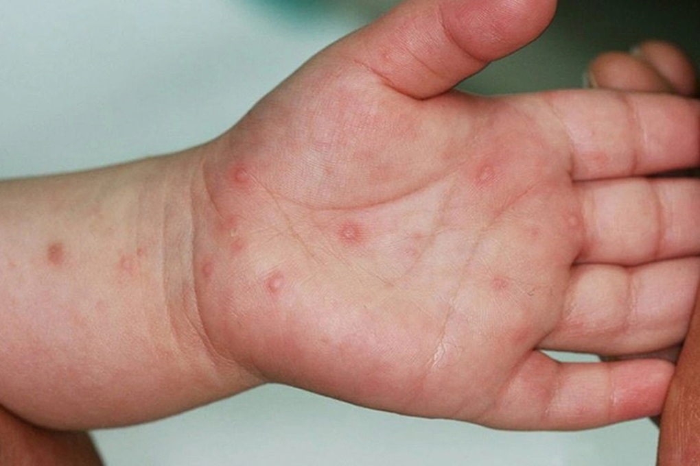 Số ca mắc tay chân miệng tăng vọt, gấp 5 lần so với cùng kỳ - 1