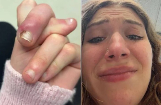 Suýt mất ngón vì thói quen cắn móng tay 1 Ngón tay sưng tấy do tích tụ mủ của Swierzewski. Ảnh: Instagram Gabby Swierzewski