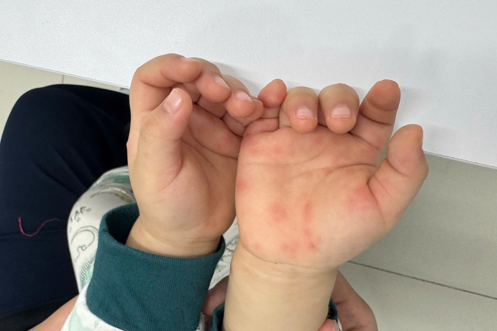 Tay chân miệng tăng nóng: Bác sĩ chỉ nguồn lây từ thứ hay bị bỏ quên - 1
