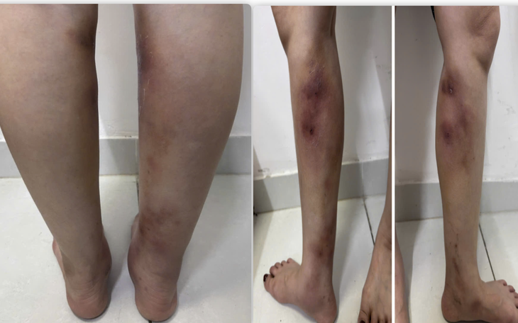 Tiêm filler 27 triệu đồng tại nhà riêng, cô gái gặp biến chứng, nhưng mất liên lạc người làm - Ảnh 1.