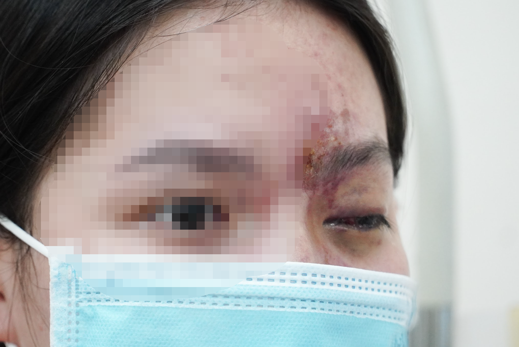 Tiêm filler có thể gây mù vĩnh viễn, bác sĩ nêu nguyên nhân phổ biến - 1