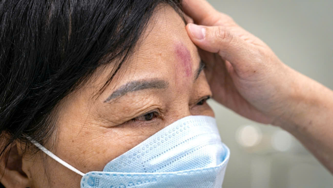 Một trường hợp tắc mạch tiêm filler nhập viện BV Da liễu TP HCM. Ảnh: Bệnh viện cung cấp