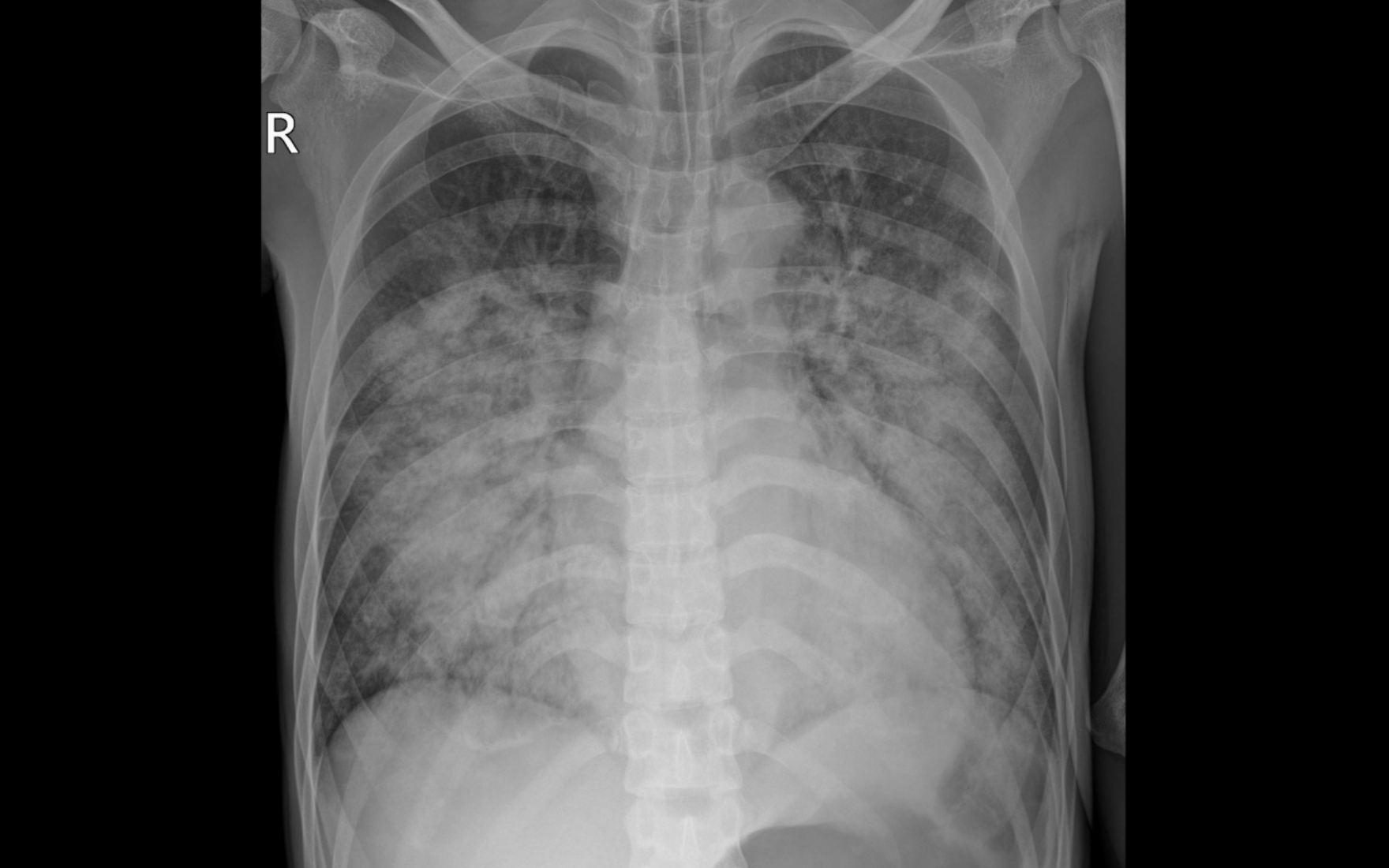 Tưởng ho thông thường, nam thanh niên rơi vào nguy kịch vì suy tim cấp 1 Phim chụp X quang thể hiện tổn thương mờ, lan tỏa 2 phổi của bệnh nhân